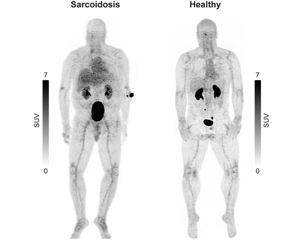 RespiratoryBMC's tweet image. 📕Article Alert 📕

Proof-of-concept PET imaging of pulmonary sarcoidosis using VAP-1-targeted radiotracer [68Ga]Ga-DOTA-Siglec-9
#OpenAccess #PET #RespiratoryResearch

Read the article: doi.org/10.1186/s12931…