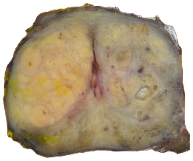 vintage81106614's tweet image. The art of grossing. A 75 yo man with urgency and hematuria. Radical Prostatectomy. Final Dx.Acinar Adenocarcinoma 4+4=8 (GG:4).Volume 60%. #pathologists#pathresidents #GUpath