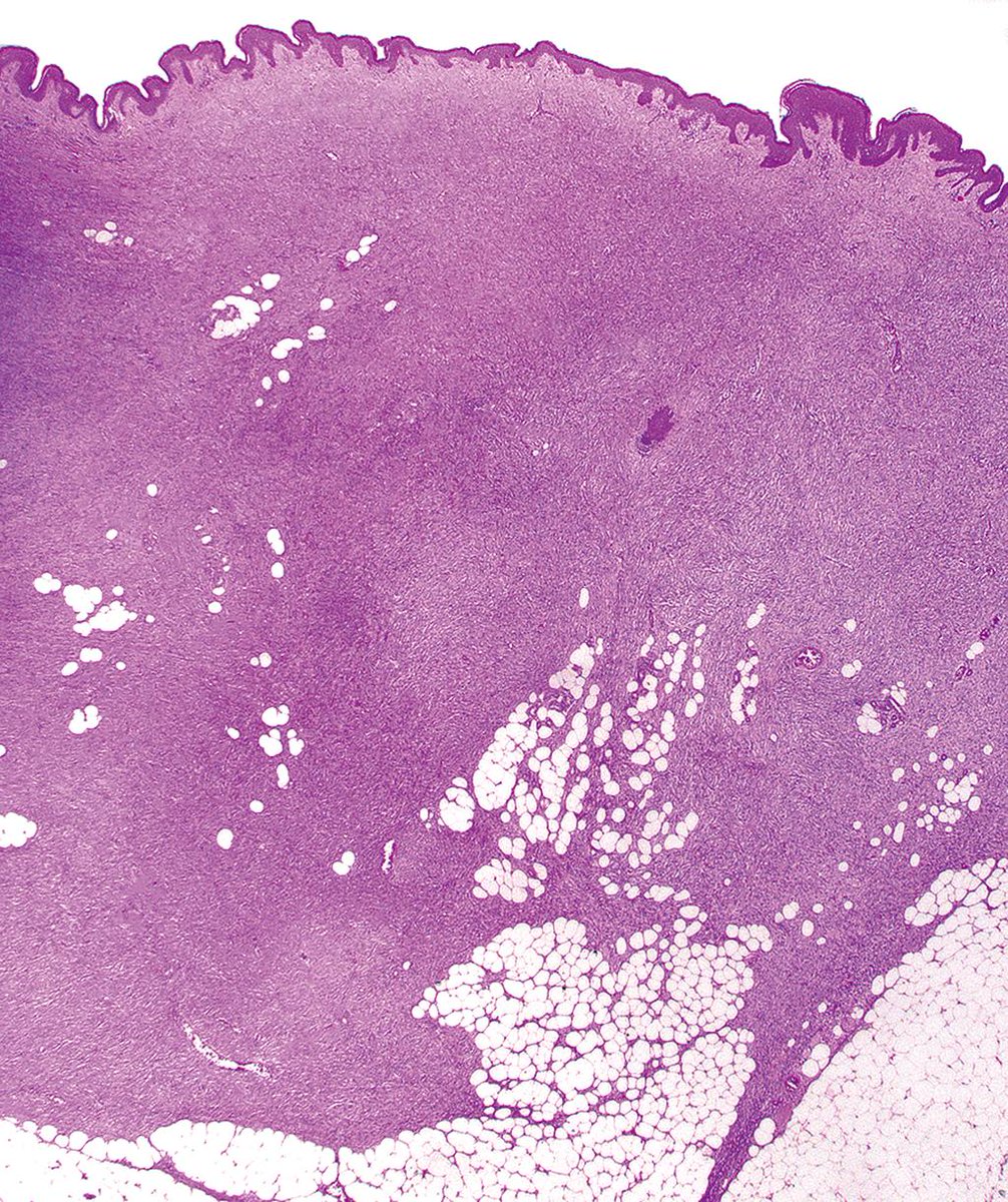 DrCycloPath's tweet photo. #PathQuiz 🔬🧶 #DermPath

A) Dermatofibrosarcoma protuberans
B) Dermatofibroma
C) Spindle cell squamous cell carcinoma
D) Desmoplastic melanoma

#Pathology #DermPath #SoftTissue https://t.co/UGGziLdwJ0
