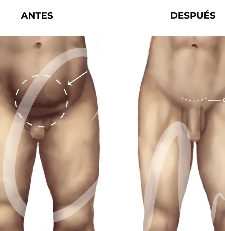 cavitación es una técnica de medicina estética no invasiva, segura e indolora, utilizada para eliminar la grasa localizada en diversas zonas del cuerpo, incluyendo el pubis (monte de venus). A través de ultrasonidos de baja frecuencia, se generan microburbujas en los adipocitos.