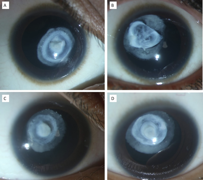 ophthopedia's tweet image. Ophthopedia Update: Morphologically similar bilateral subluxated cataracts in two siblings managed by lensectomy and glued intraocular lens dlvr.it/TS59mT #Ophthalmology #Eye #Ophthotwitter