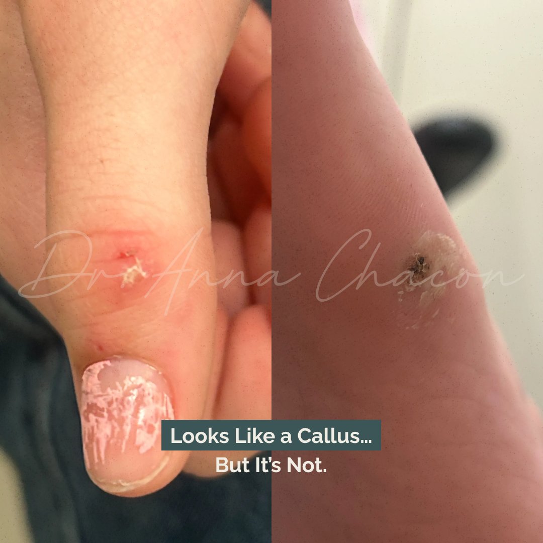 DrMiamiDerm's tweet image. Looks like a callus… but it’s actually a plantar wart

Caused by HPV, plantar warts often show tiny black dots (clotted capillaries) and can grow inward due to pressure from walking.

Painful, persistent, and often mistaken for dry skin.

#Dermatology #PlantarWart #SkinHealth