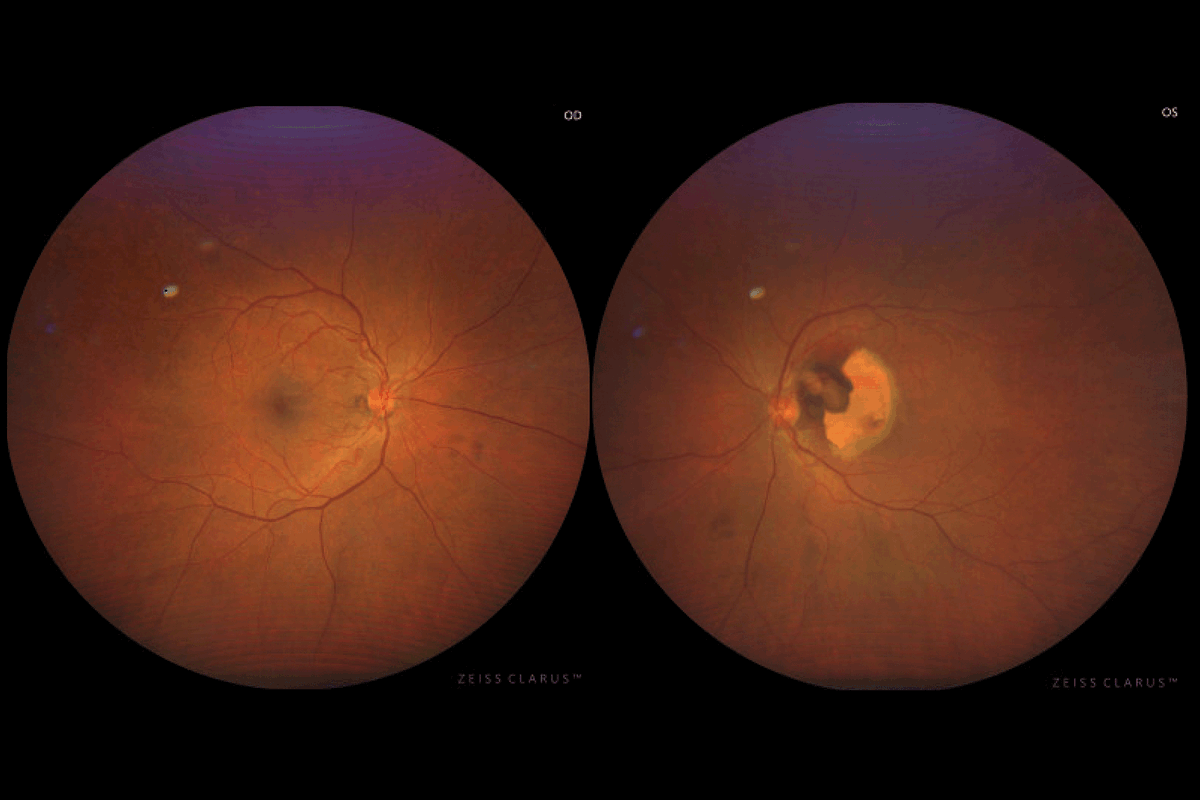 opto_advisor's tweet image. A 70-year-old patient has had blurry central vision in 1 eye for a month. 

Can her clinical images explain the cause?

Test your knowledge here: bit.ly/4vAho19

#Optometry #MacularDegeneration #Retina #AntiVEGF  #MedicalEducation