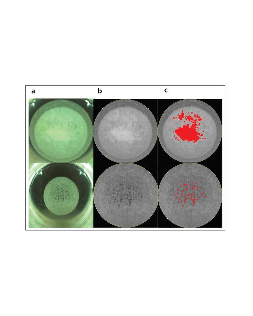 JRSJournal's tweet photo. Analysis of black spot and opaque bubble layers. (A) Image captured by camera inside the ATOS (SCHWIND eye-tech-solutions). (B) Image converted to grayscale. 

Read more: https://t.co/5EO5QLkRQn

#ophthalmology #refractivesurgery https://t.co/WKU7C5VemD
