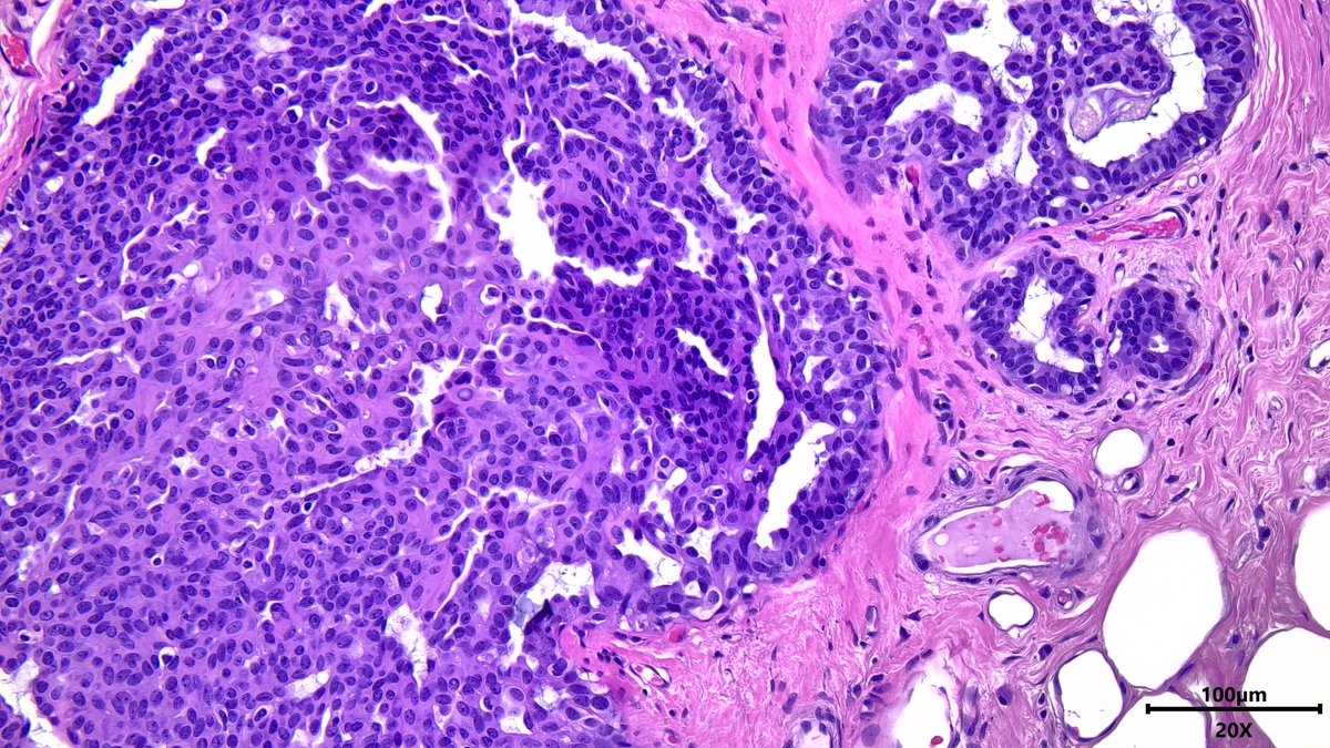 VickeryJasmine's tweet image. Usual ductal hyperplasia with focal central necrosis? Just by morphology no stains performed. Not very common but let me know if you agree or disagree #pathtwitter #pathX #breastpath