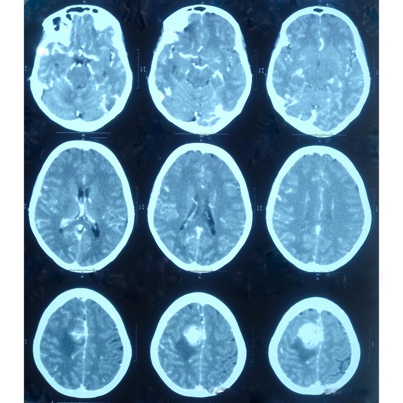 MayoClinic's tweet image. Mayo Clinic researchers are outlining a new era of care for patients with meningioma, the most common type of primary brain tumor.

A new review highlights how advances in precision oncology — from molecular classification to advanced imaging and targeted therapies — are helping
