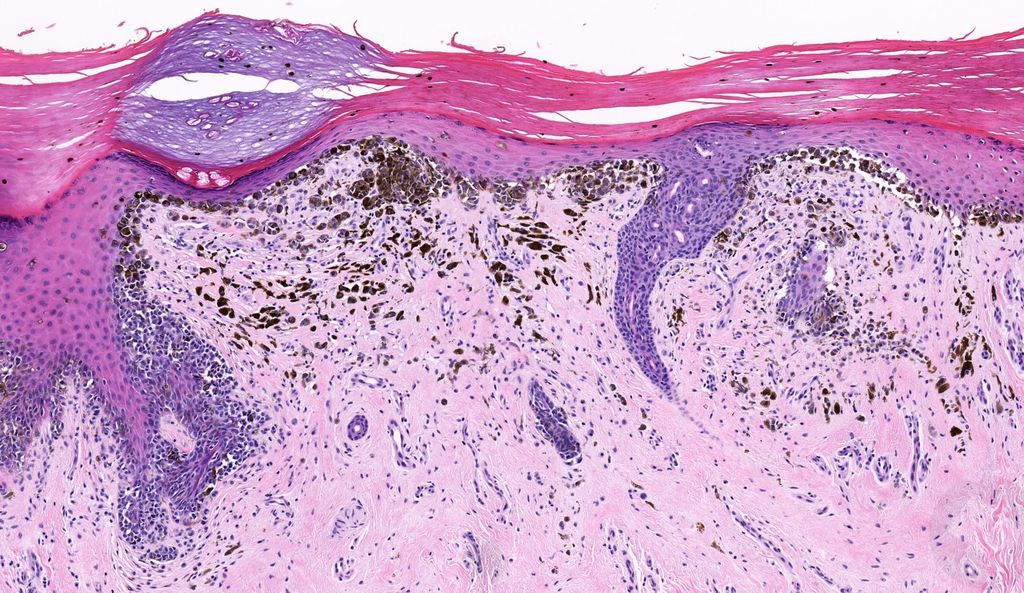 JMGardnerMD's tweet image. 60 yo M. Large dark brown patch on plantar foot. Your diagnosis? 
Answer ✅ youtube.com/watch?v=FMabvm… 
WSI digital slide: kikoxp.com/posts/2813. 
#pathology #pathologists #pathTwitter #dermpath #dermatology #dermatologia #dermtwitter
