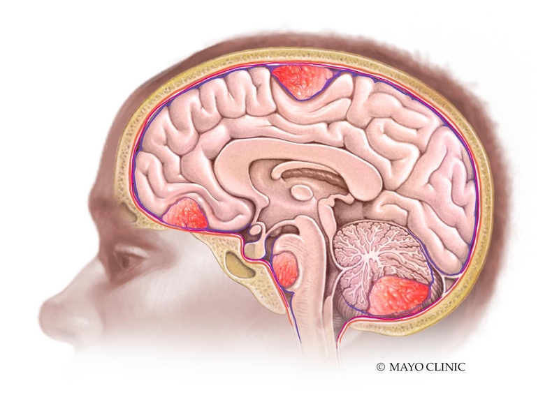 Mayo Clinic Neuro tweet media