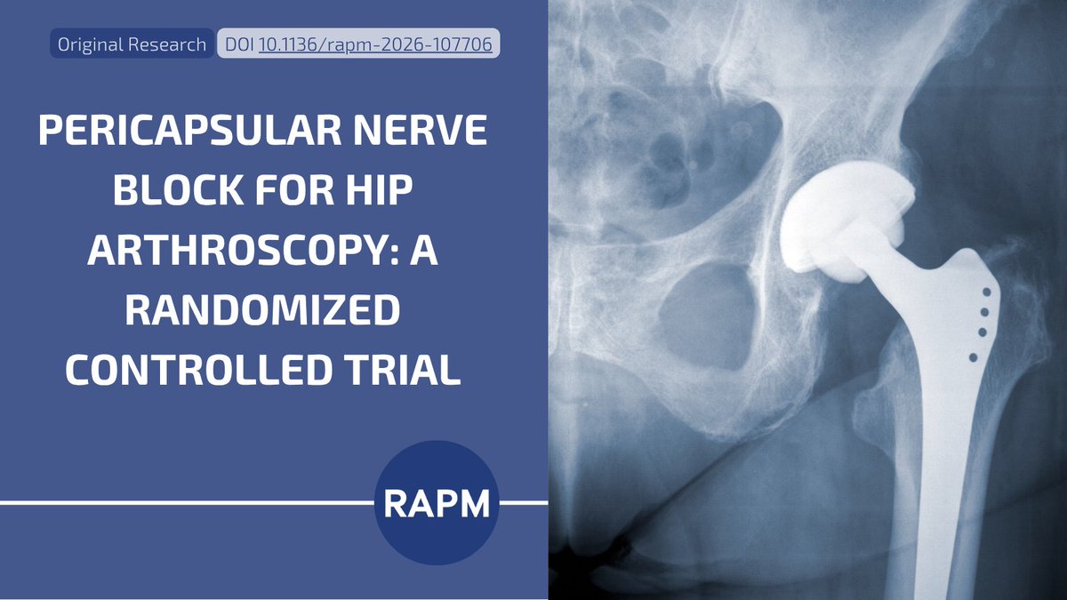 RAPMOnline's tweet photo. 🔍 PENG block for hip arthroscopy—game changer or not?

📚 A RAPM RCT shows ↓ PACU opioids &amp; shorter stays, but no benefit in 24h opioids, pain, or recovery.

💡 Takeaway: modest early gains, no overall impact. Not ready for routine use.

🔗 https://t.co/bbfGUoiLfE

#RAPM https://t.co/T8LLsGvz0O