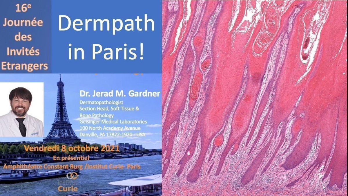 JMGardnerMD's tweet image. My 2021 Paris #Dermpath Course (5 hours!) at Institut Curie for IAP France - adnexal tumors, soft tissue, melanocytic, &amp;amp; more. 
Video: youtube.com/watch?v=5ixiza…  
#pathology #pathologists #pathTwitter #dermpath #dermatology #dermatologia #dermtwitter