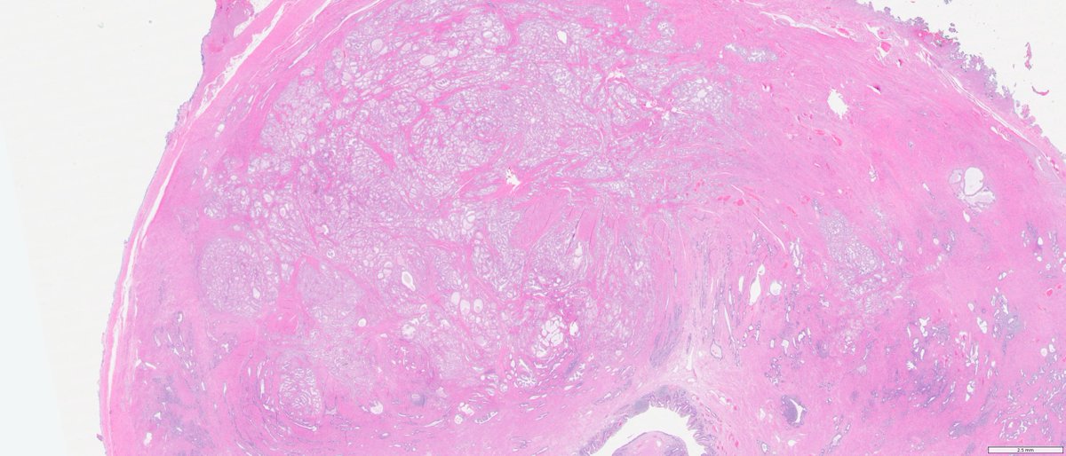 slusagar's tweet image. while we've had concurrent digital avail for past several years for routine🔬cases, only recently have we been able to have digital scans for the whole mount prostatectomies we do

nice #GUpath #grosspath correlation of prostate cancer

#makingprostatepathfunagain