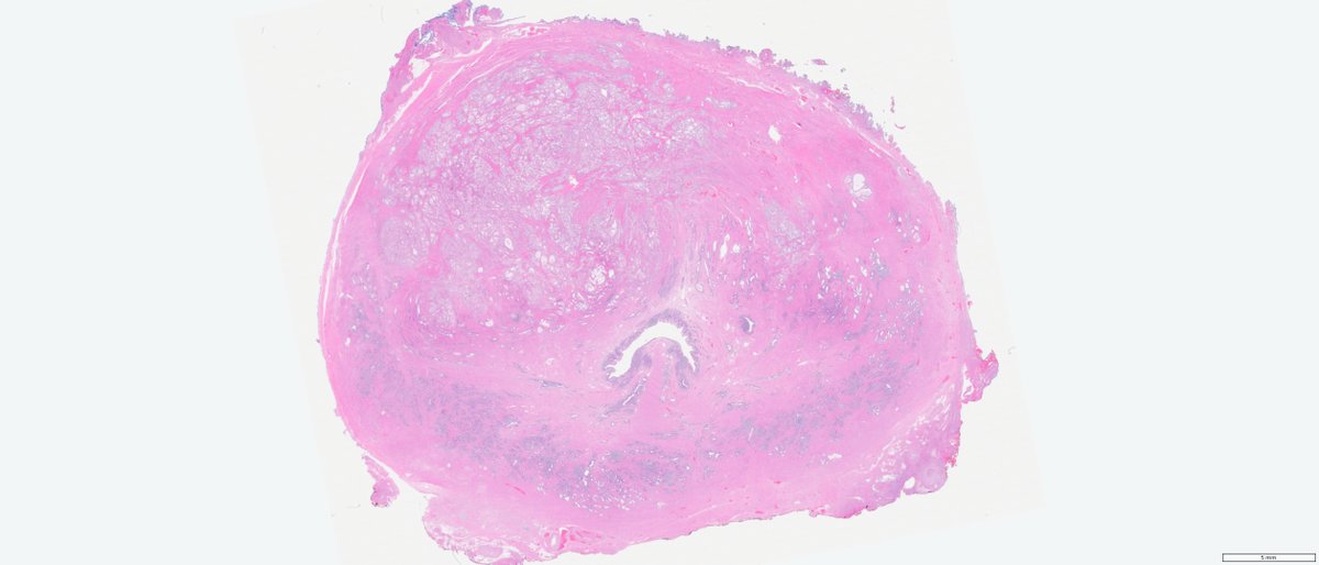 slusagar's tweet image. while we've had concurrent digital avail for past several years for routine🔬cases, only recently have we been able to have digital scans for the whole mount prostatectomies we do

nice #GUpath #grosspath correlation of prostate cancer

#makingprostatepathfunagain