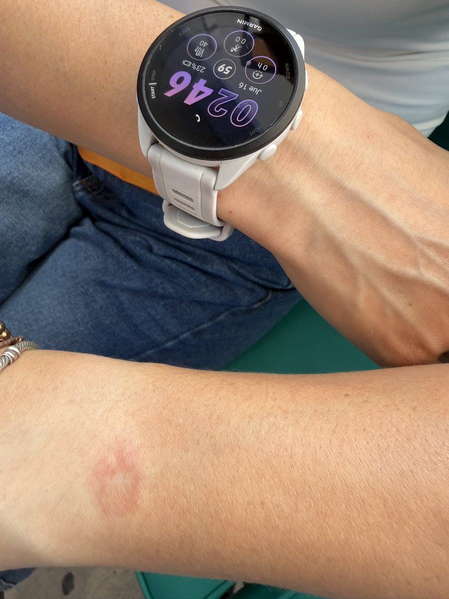 RIKARDIU's tweet photo. Con mucho entusiasmo mi esposa estrenó su reloj @GarminMexico pero algo sucedió y le causó esta lesión, tendrá algo mal el dispositivo?? 😥😩 https://t.co/Ug4s68lXUr