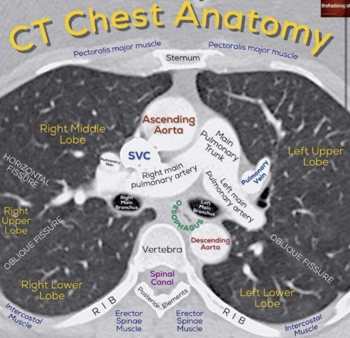 ZainKhalpey's tweet image. Reading a CT chest is about recognizing structures and how they relate. 

Small details can guide diagnosis and next steps in care.

@radiologistpage 

#MedTwitter #Radiology #MedicalImaging #Cardiology