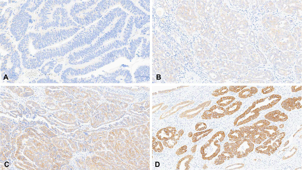 ArchivesPath's tweet image. 📣 Check out the updated protocol: Reporting Results of Biomarker Testing of Specimens From Patients With Carcinoma of Gynecologic Origin 👉 doi.org/10.5858/arpa.2…

#CAP #Archives #GYNPath