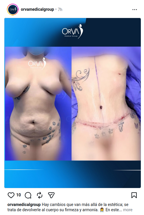 Literal, le quitaron como 10 paticas jajajaja