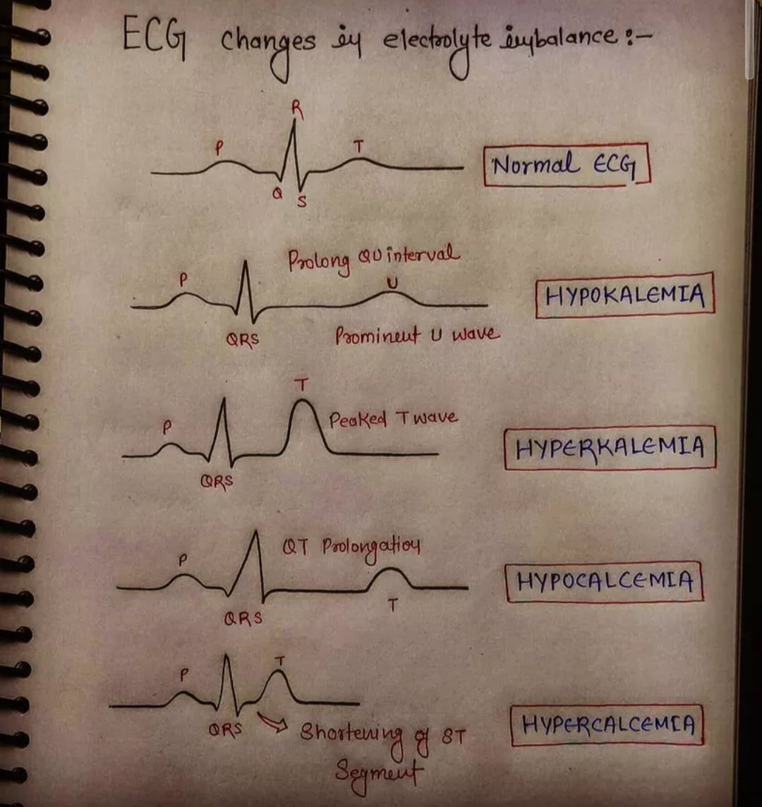 ECG Changes in electrolyte imbalance
