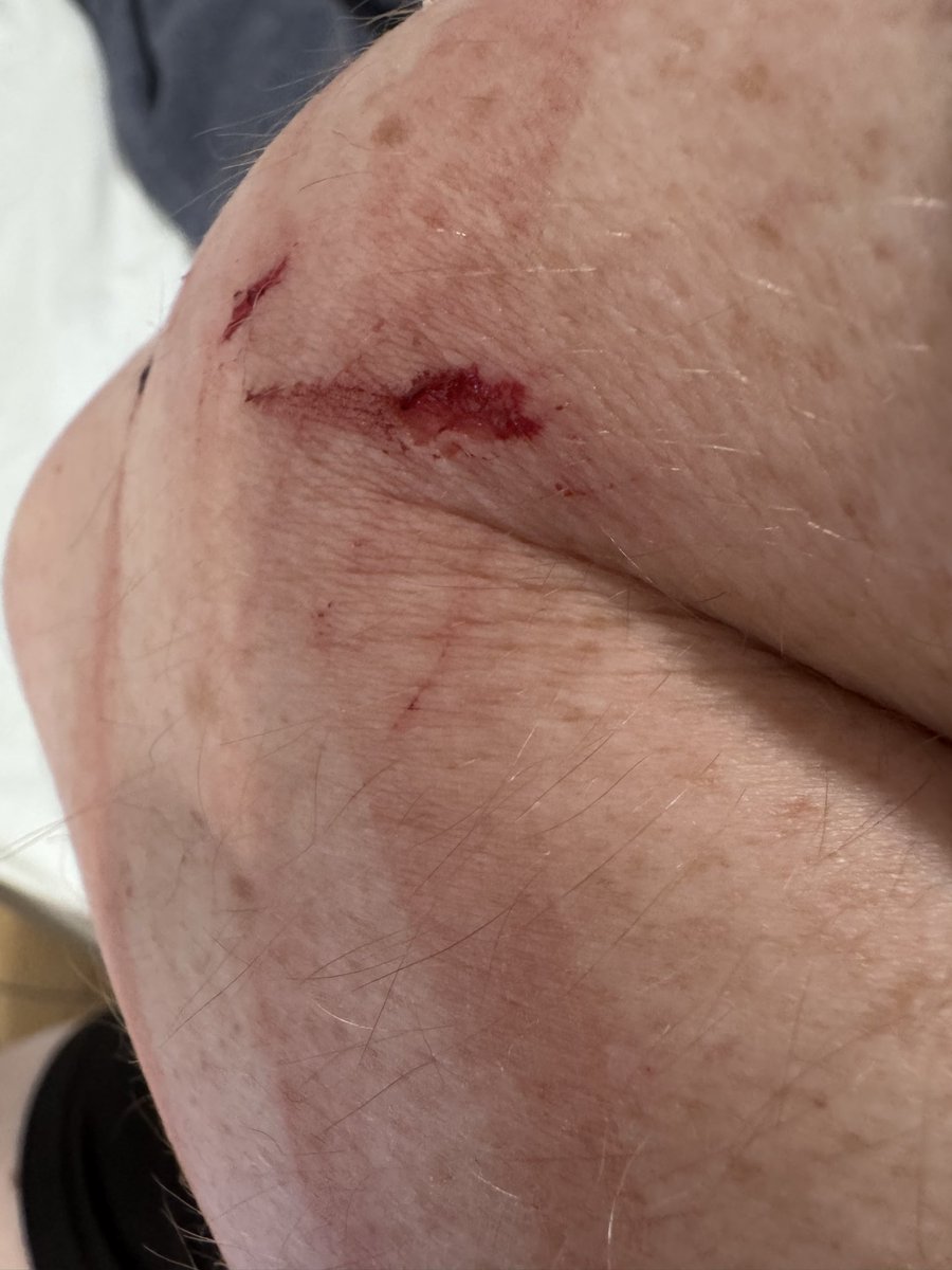 samrolken's tweet photo. After I was injured by a glass shower at an @Airbnb , @AirbnbHelp expects me to pay! There are many options besides Airbnb. Don’t use them. https://t.co/69KyF15Eax