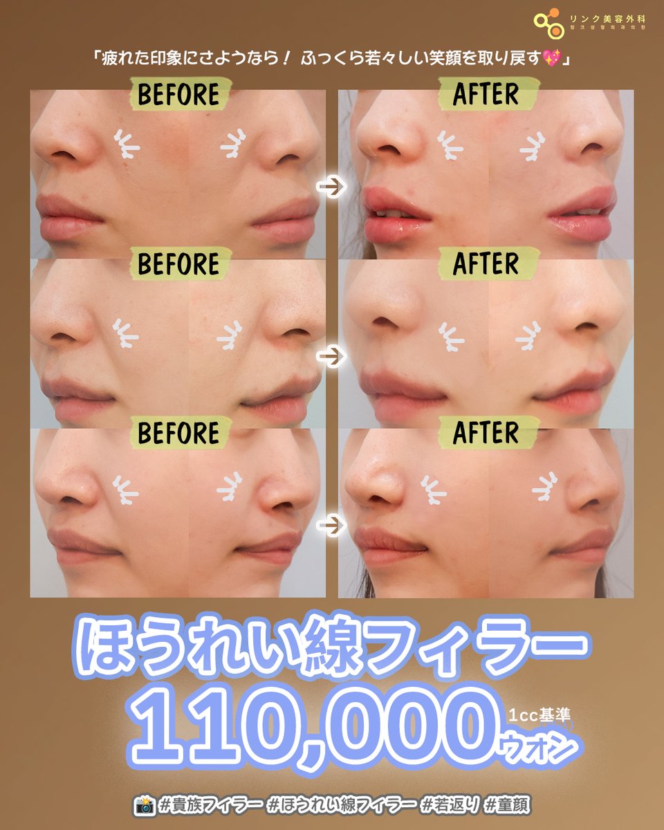 kankokuseikei_'s tweet image. 次の渡韓予定の女子必見👀🇰🇷

話題の「ほうれい線フィラー」で疲れた印象にさよなら👋

韓国・リンク美容整形外科の代表院長による神業＆超丁寧な施術で、自然なふっくら笑顔を取り戻せます💖

最高の韓国旅行の思い出と一緒に、若々しい美しさも手に入れませんか？✨

#ビフォーアフター #kbeauty