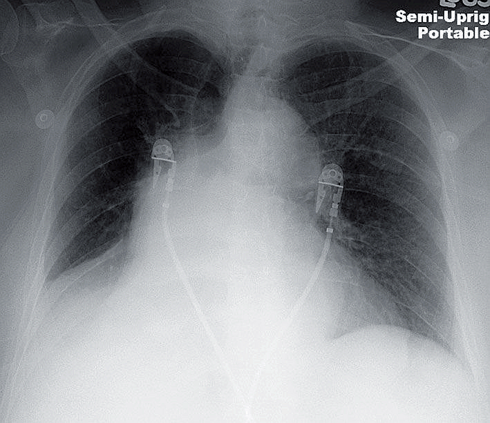 ManualOMedicine's tweet image. 69-year-old woman is admitted for hemoptysis.
- What do you see on the chest x-ray ?

#foamed #meded #foamrad #radiology