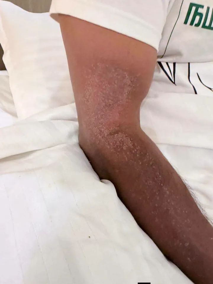 தொடர் தேர்தல் பிரச்சாரம் பண்ணி பண்ணி அண்ணன் சீமானின் கையை கவனிக்கவும் 🥹🥹🥹,
உடல்நிலை எவ்வாறு உள்ளதோ 🥲🥲🥲