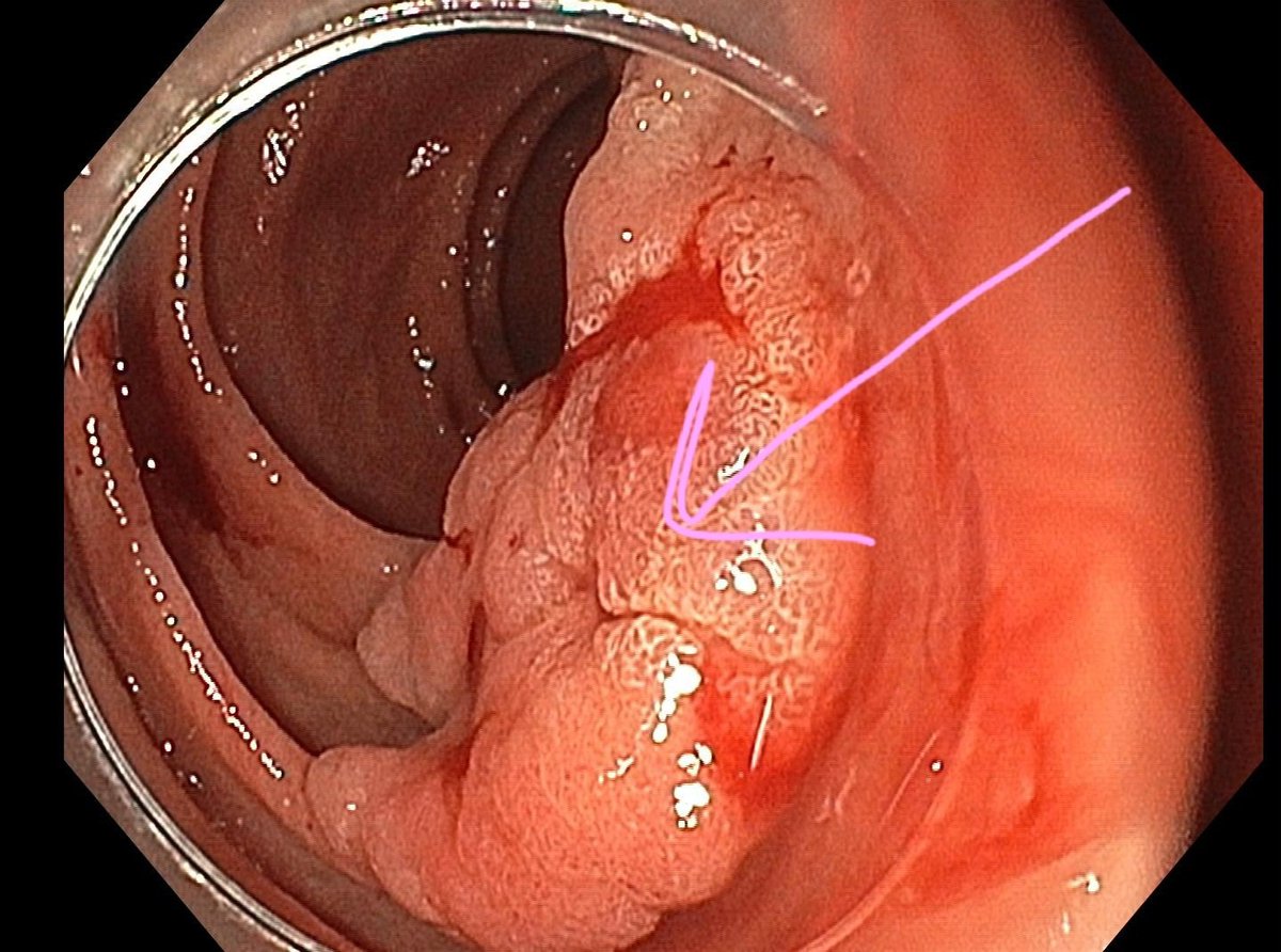 GavricAle's tweet photo. Went for cold pEMR. 

The patient returned  (12h) to the emergency unit with abdominal pain (pancreatitis). 

This was periampullary lesion.

Basics: when dealing with polyps in this region, always confirm that the papilla is intact. https://t.co/yypcPPx0jZ
