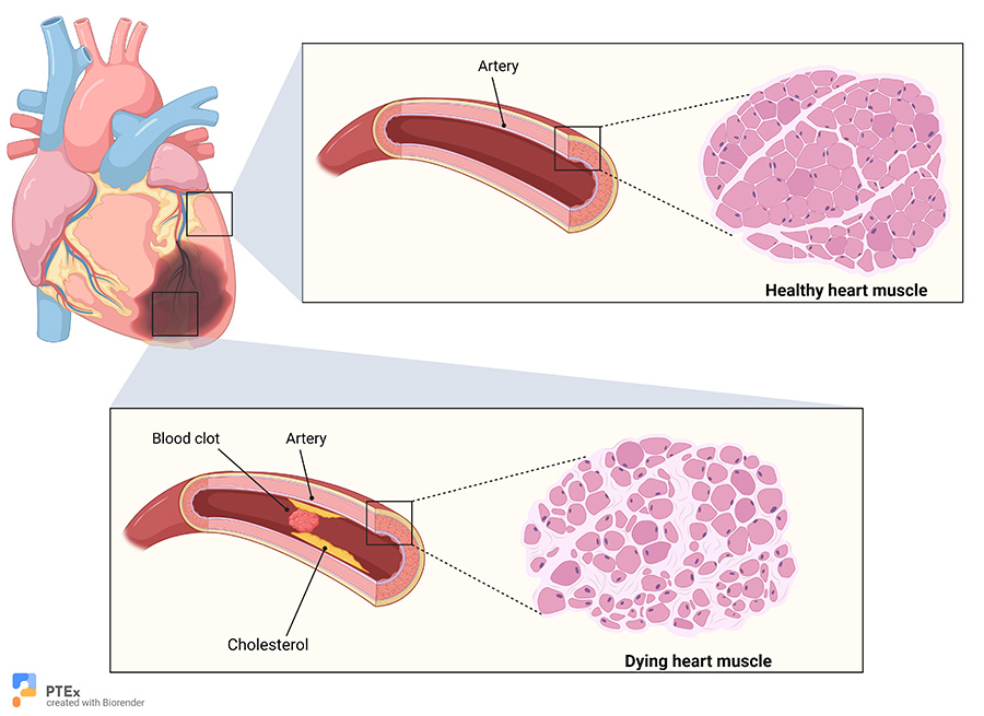 PathologyTests's tweet photo. Troponin T is a blood test that helps doctors detect damage to the heart muscle. It’s often used with an ECG when a heart attack is suspected. Levels can rise within hours, helping emergency teams act fast. Learn more with Pathology Tests Explained. https://t.co/PqM6oZ7QBI https://t.co/WhQu939ilS