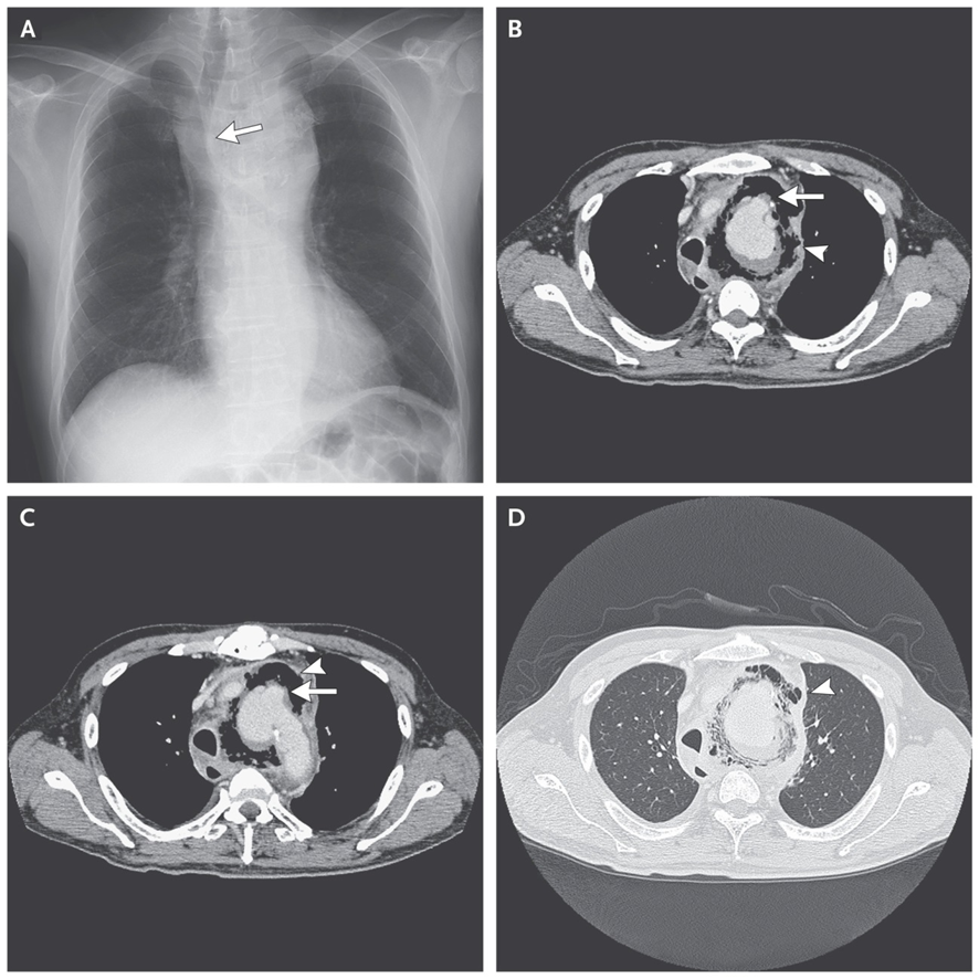 guerreroespejo's tweet image. A 66-YO♂️: 1-month of #fever &amp;amp; 4 days of hoarseness.
⬆️Leukocyte count 
XR:⬆️enlargement of the aortic arch, deviation of the trachea (A, arrow).
CT: aortic pseudoaneurysm (B &amp;amp; C, arrows), surrounded by gas collection (B, C, &amp;amp; D, arrowheads).
1/2

DOI: 10.1056/NEJMicm1508258
#IDX