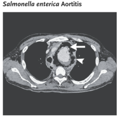 guerreroespejo's tweet image. Blood🧫: #Salmonella enterica

SALMONELLA ENTERICA AORTITIS

The patient had a sudden collapse on rupture of the infected aneurysm: urgent graft-replacement surgery followed by stent replacement after the postoperative development of an esophageal fistula. 
2/2

#medicine