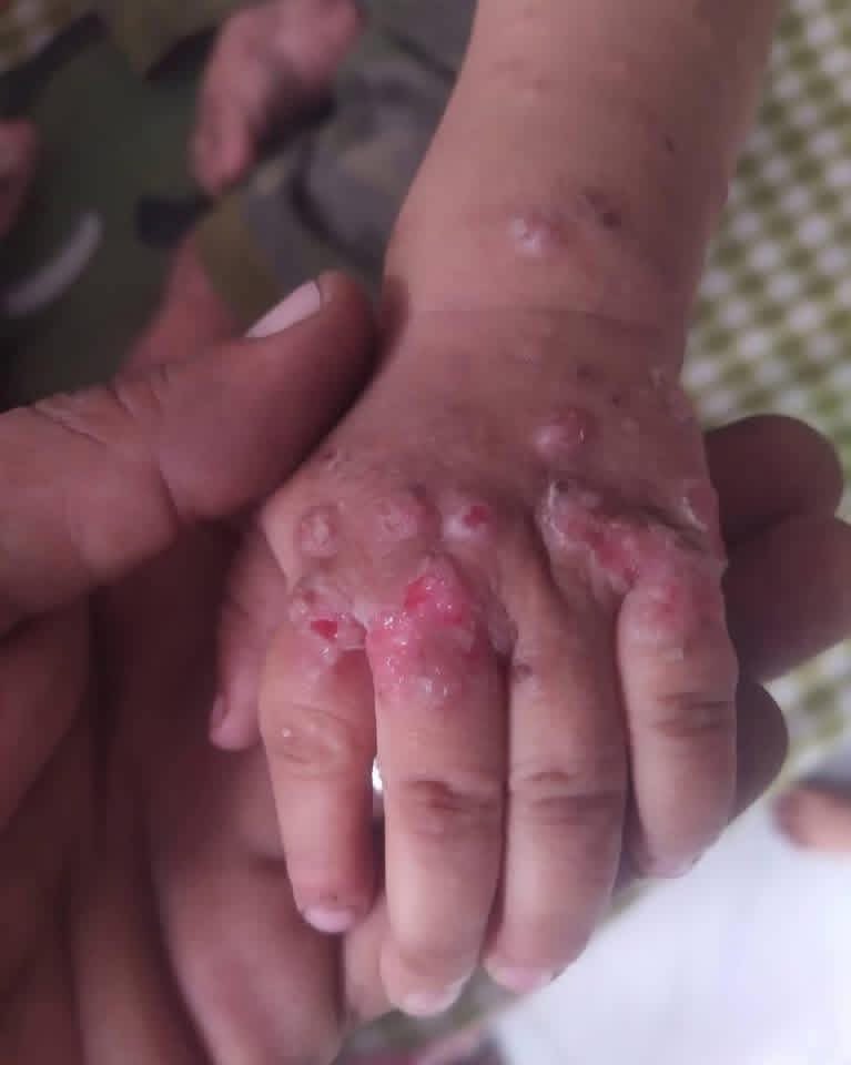 I NEED TREATMENT😭

︎
︎

︎

︎

︎
︎

︎

︎

︎

we’ll remind you 🥺
︎

︎

︎

︎

︎
︎

︎

︎

︎

︎
︎

︎
︎

︎
︎

︎

︎

︎

︎
︎

︎

︎

︎

that
︎

︎

︎

︎

︎

︎
︎

︎

︎

︎
︎
💔
︎

My child has scabies, please help me. $50
chuffed.org/project/154635…