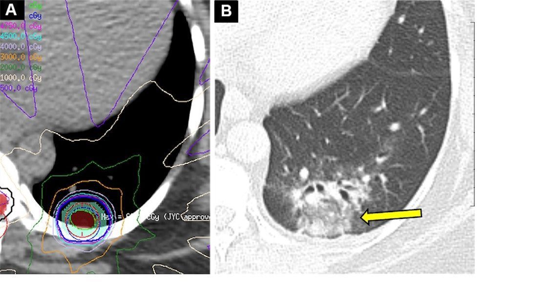 AuntMinnie's tweet photo. How best to characterize CT lung findings after radiation therapy #radiology #HPRT #lungcancer @HUSI_Investiga https://t.co/ajYBLTCWdq https://t.co/Ib77qoAxNR