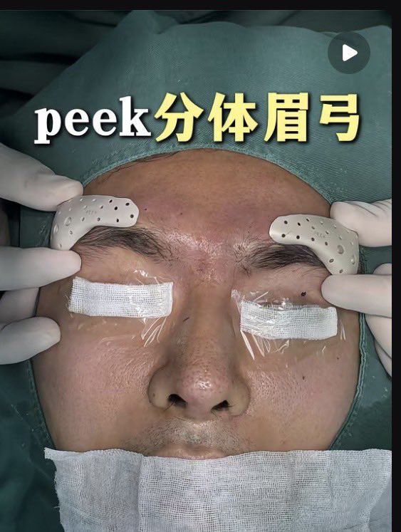 kaijisei's tweet photo. 少し前に上海に眉骨プロテのカウセ行ってきたので、レポします！！！

【中国眉骨プロテカウセレポ】

病院：上海悦欧医療美容
X：xingcan_jp
選定理由：そもそもXで日本人受付しているのがここしかなかった

・眉骨(眉弓)、眉間(眉心)のプロテーゼ
・既製品(1枚目)だと20000元（46万円）
・オーダーメイド(peek)の場合は25000元（58万円）
・切開位置は眉下。範囲狭く傷跡目立たない
・オーダーメイドを作らないと一体型にできない（画像1枚目がオーダーメイド、2枚目が既製品）
・オーダーメイドだと自分の眉骨に合わせて高さもカスタマイズ可能
・I型のプロテーゼが今鼻筋に入っていても問題ない。
・LINEの返事がとにかく遅く、会話も噛み合わないことが多かった。
・病院が独自契約している中国人の通訳さんだったが、正直日本語をすらすら話せるレベルとは程遠く、質問回答もうまく帰ってこなかった（いい人ではあったけど）
・実際に眉骨プロテを入れている男性のスタッフさんを見せてもらったが、顔に立体感があって格好良かった
・入院なし、3DCTは日本で撮ったやつでもokとのこと（ほんまか？）
・CTない場合は、オーダーメイドの場合は出来上がるまで7〜10日かかるので、カウセ→手術をしなければならない
・通訳さんが、正直ほかに良い病院はあると言っていた()

普段韓国での通訳さんのレベルが高いから気づかなかったが、通訳さんが整形慣れしていることとか日本語ペラペラ話せることの重要性に改めて気づいた。
もう一回中国に行くのが嫌で諦めたが、中国カウセするならちゃんとレベルの高い通訳さんをつけないとカイジのように金ドブになると思った。通訳さんにおすすめの病院聞くのが良いかも。(基本掛け持ちのようなので)
