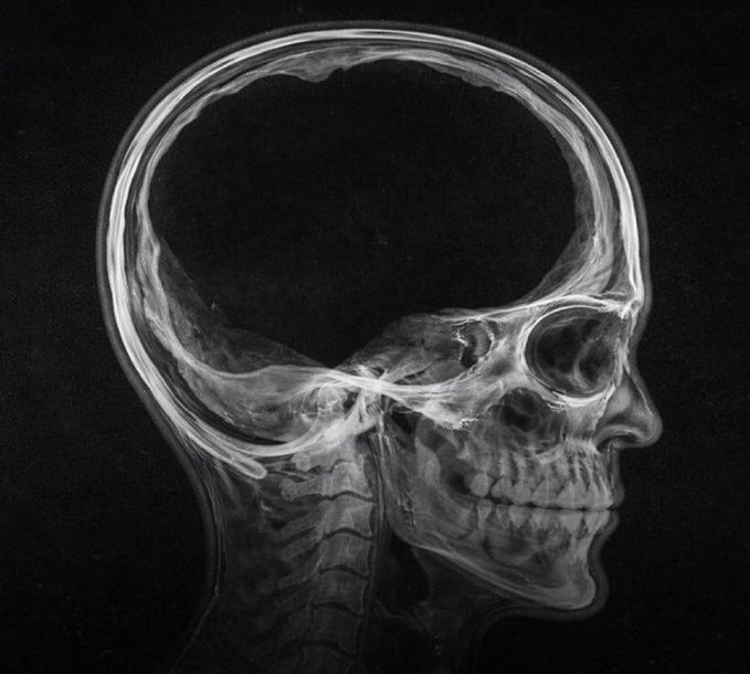 JiahaoWangQuant's tweet photo. Hello genny narrative, how did we miss this?

There are alot of posts about this man who lost 90% of his brain basically making him brainless and people are memeing him.

We are all brainless buying memecoins.

$Brainless

Check the page down below.

https://t.co/cJ2OeJSR3s https://t.co/zUlsLtWrYc
