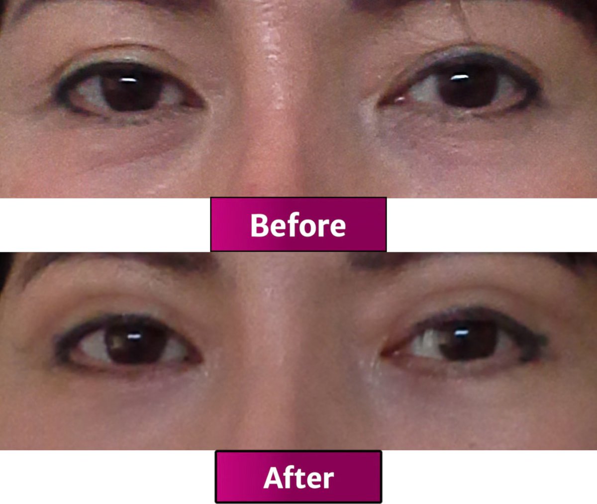 RGuanzonMD's tweet photo. Upper and Lower Eyelid Surgery (Blepharoplasty) by Dr. Raul Guanzon from Metro Manila, Philippines

Deep set eyes, double eyelid, lower eyelid procedures

Web : https://t.co/DjWawJVfuR

#Blepharoplasty #eyelidsurgery #eyelidlift https://t.co/L0Z55eGrlR