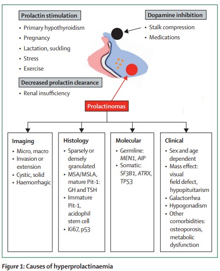 TheLancetEndo's tweet image. #Hyperprolactinaemia can result from physiological causes, pharmacological agents, or pathological conditions such as #prolactin-secreting #pituitary #adenomas and other pituitary stalk-compressing masses thelancet.com/journals/landi… 
#prolactinomas