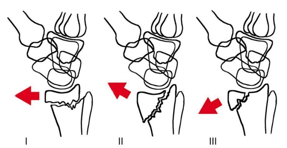 MoAImam's tweet photo. Smith’s Fracture Classification

Type I: Extra-articular

Type II: Intra-articular, involving the dorsal joint surface

Type III: Intra-articular, entering the radiocarpal joint (volar Barton’s) https://t.co/vgWaKyF9Hb