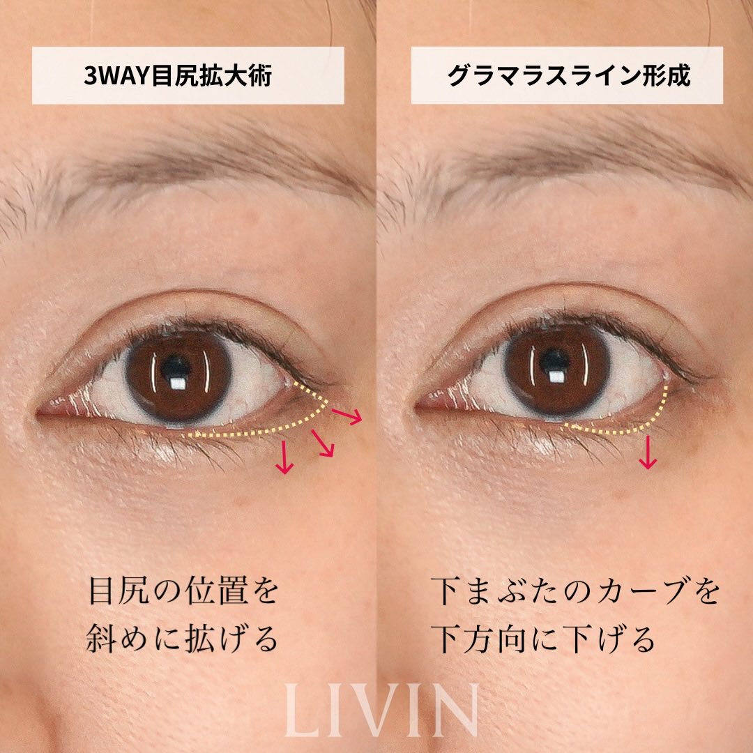 新行内芳明【自然で美しい目整形・鼻整形・ヒアルロン酸】 tweet media