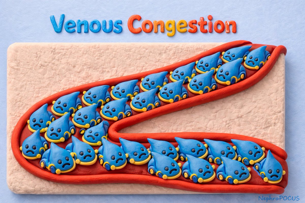 NephroP's tweet image. Enjoyed speaking on #VExUS and #POCUS today at the @UWHealth School of Diagnostic Medical #Sonography Spring Conference.
Sonographers play a key role in recognizing and reporting subtle clues of congestion in a timely way, so it really helps when they understand the clinical