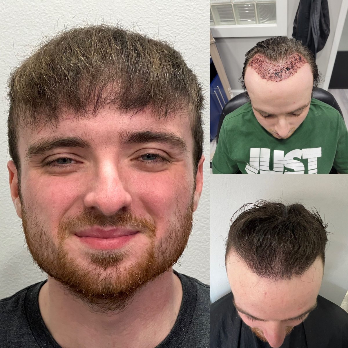 ManeImage's tweet image. Getting a hair restoration procedure gives you back the hair you desire.  

Trust Mane Image Hair to provide you not only the latest techniques, but the most skilled surgeon and a thorough aftercare protocol.  

Wegrowhairchicago.com

#fue #fut #experts #localcare #40years