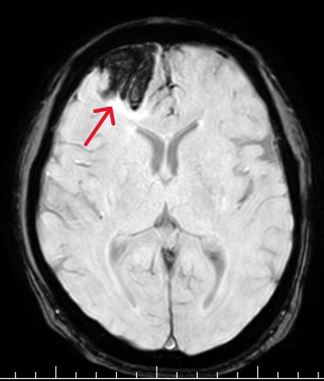 Neurology case discussion for doctors 🔸59 year old man presented with ...