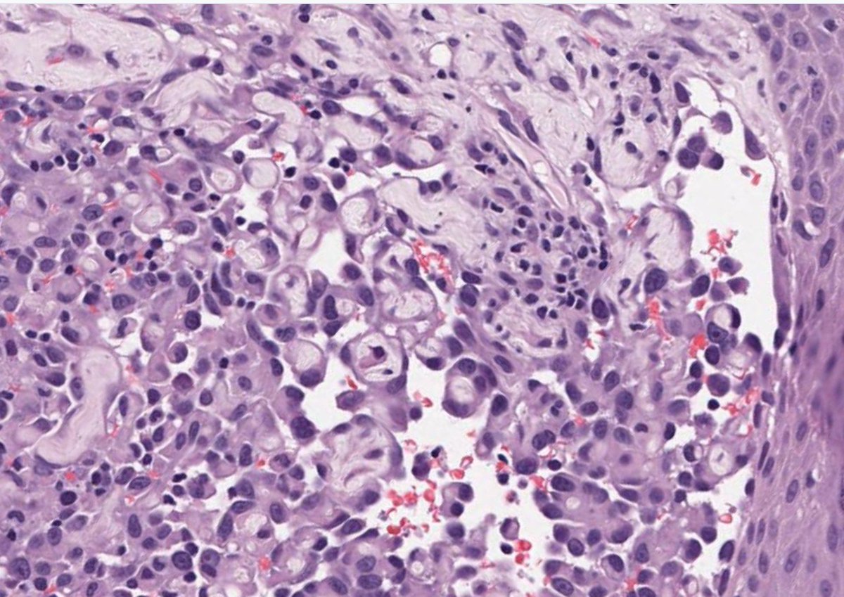 JMGardnerMD's tweet image. Red purple nodule on scalp of 80 yo man. Your diagnosis? 
Answer ✅ buff.ly/3b4NrgT. 
WSI digital slide via @ pathpresenter: buff.ly/2G5S13g. 
#BSTpath #pathology #pathologists #pathTwitter #dermpath #dermatology #dermatologia #dermtwitter