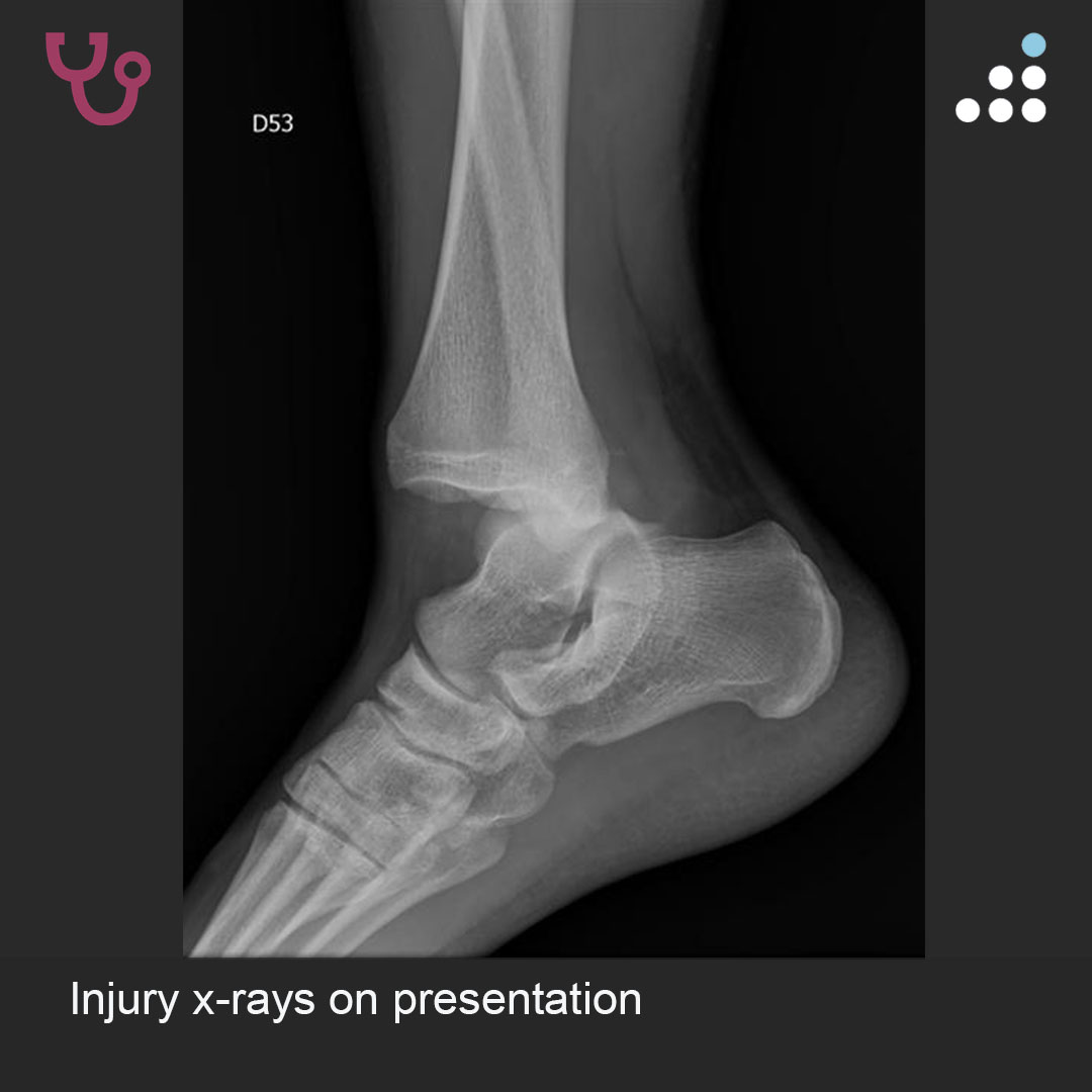 orthobullets's tweet image. Here is a new case by Dr. Camilo Delgadillo and Fundación Santa Fe de Bogotá (@FSFB_Salud).

ANKLE FRACTURE-DISLOCATION WITH SYNDESMOTIC DISRUPTION AND MEDIAL WIDENING IN 27M

How would you manage this #orthotwitter?

Vote on this case for CME: orthobullets.tiny.us/2p8z6sku
