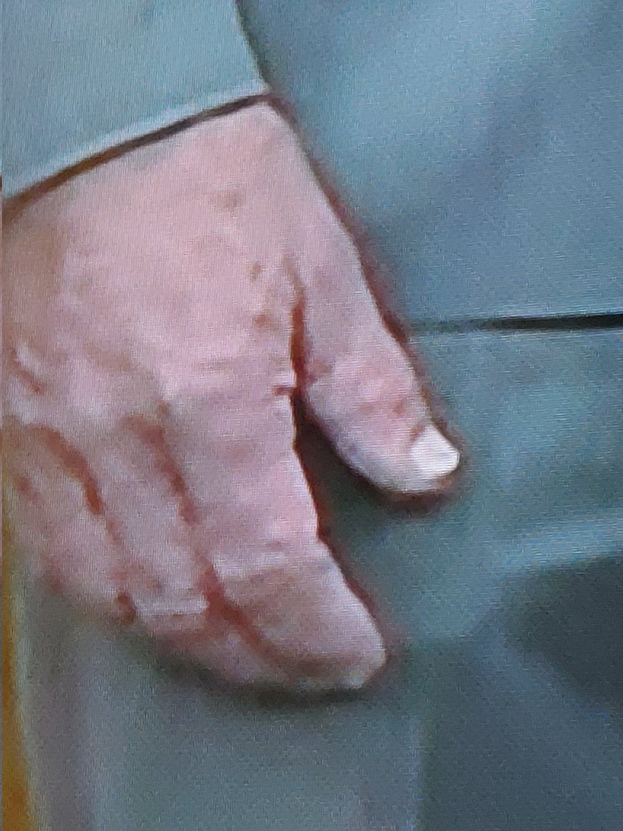 BClinical79's tweet photo. Ewww, look at the black hands of death, bye bye RFK jn https://t.co/5DTmhAmKW6