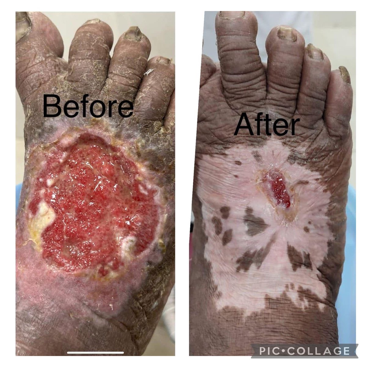 PRP and PRF works wonder in wound healing