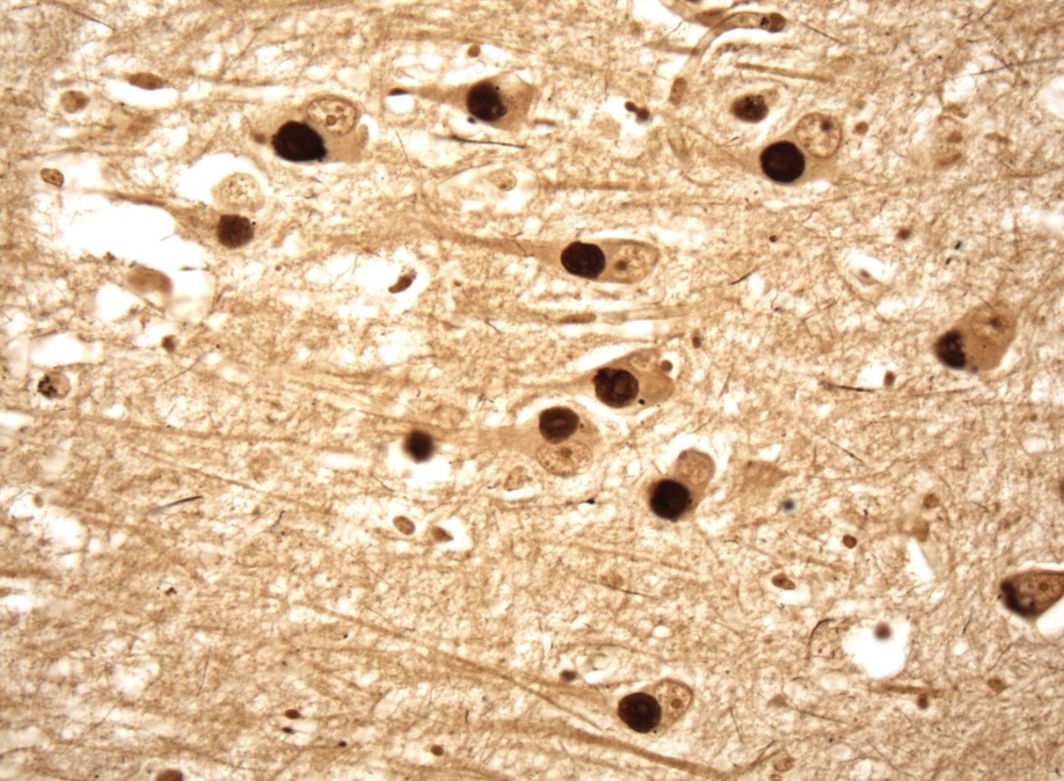 BrownPathology's tweet image. #Pathresidents #Neuropath #Pathtwitter

Exciting news: @BrownPathology has an opening for our 2-year, ACMGE-accredited neuropathology (#neuropath) Fellowship (2026-2028)!

Come train in a leading, high-volume academic center with advanced, personalized instruction by
