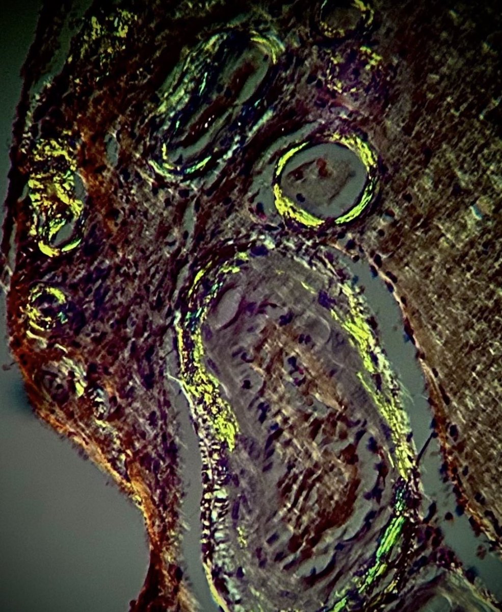 BrownPathology's tweet image. #Pathresidents #Neuropath #Pathtwitter

Exciting news: @BrownPathology has an opening for our 2-year, ACMGE-accredited neuropathology (#neuropath) Fellowship (2026-2028)!

Come train in a leading, high-volume academic center with advanced, personalized instruction by