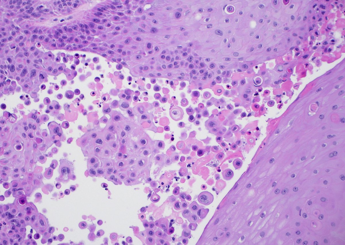 JMGardnerMD's tweet image. Skin biopsy from sun damaged skin in elderly man. Diagnosis? Answer youtu.be/1gPZDfMabGg #pathology #pathologists #pathTwitter #dermpath #dermatology #dermatologia #dermtwitter