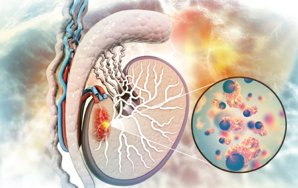 NursingJournal_'s tweet image. NCPD opportunity!

Testicular cancer is the most prevalent malignancy in males ages 15 to 35. Learn how to provide optimal care to patients facing this diagnosis. Expand your skills with this new NCPD article: ow.ly/lUkR50YFgUF #cancercare #oncology #menshealth #nurses