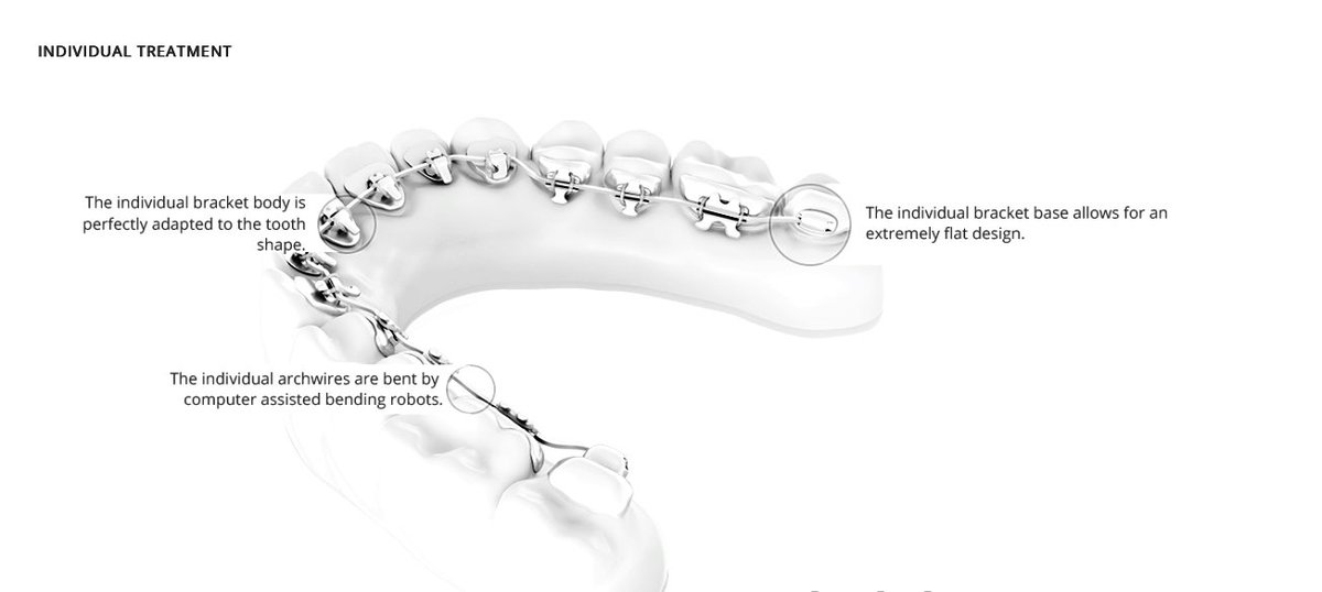 How do Braces Behind the Teeth Work? | Dental Treatment Information #lingualbraces #orthodonticshttps://cosmetic-dental-treatments.info/how-do-braces-behind-the-teeth-work/
