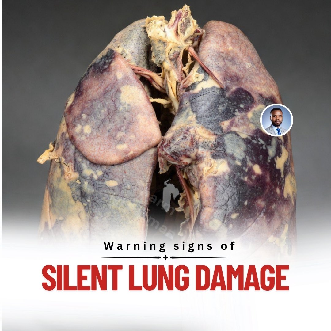 OGreat6's tweet photo. BAD NEWS …..

Your lungs can be failing quietly, and you may not notice until it’s serious. Do not wait for breathlessness to scare you.

Learn the top 5 warning signs your lungs are silently failing, and how to avoid them on this thread

Check my comments below 👇🏾 
Bookmark for later